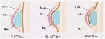 王俊河醫(yī)生隆胸的技術(shù)優(yōu)勢3