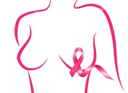 乳腺癌示意图