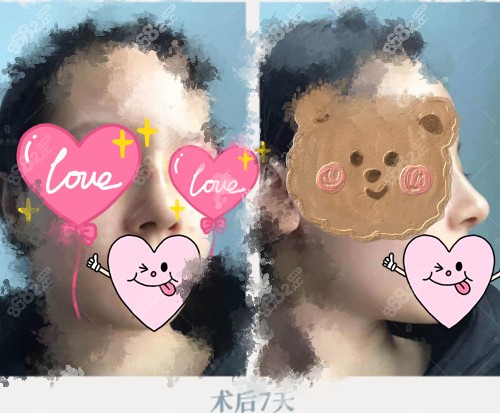 范荣杰做鼻子术后7天恢复状态