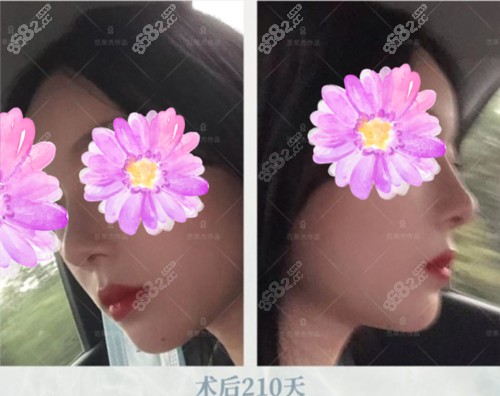 范荣杰做鼻子术后210天恢复状态~