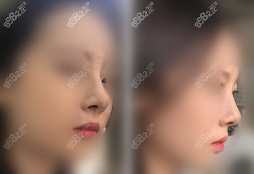 上海聯(lián)合麗格范榮杰做鼻子病例術(shù)后4個月