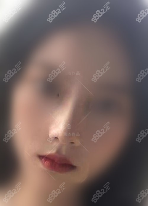 上海聯(lián)合麗格范榮杰做鼻子病例術(shù)后半年正面