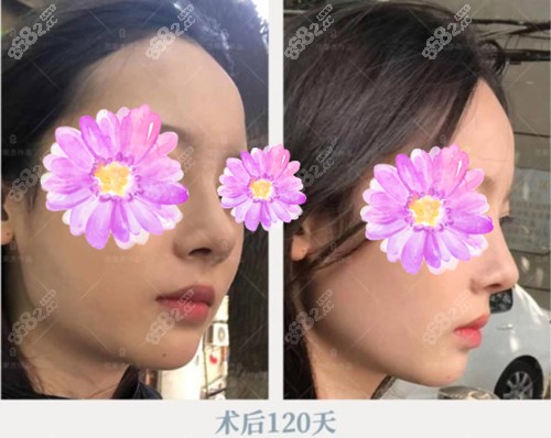 范荣杰做鼻子术后120天恢复状态~