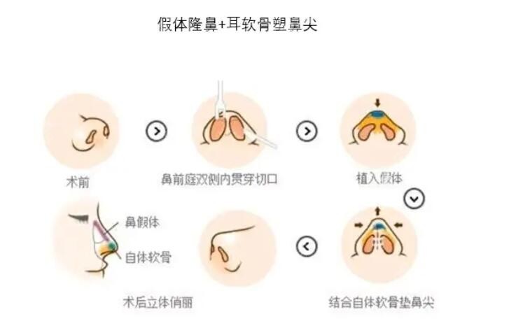 垫鼻尖图解图片