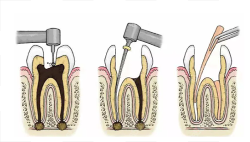 根管治疗