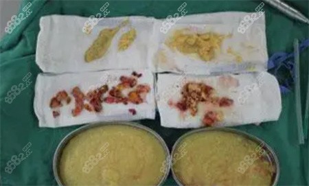 南京奧美定取出 南京奧美定取出