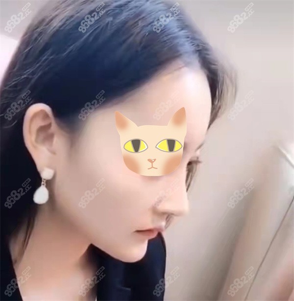 广州崔东做鼻修复怎样？