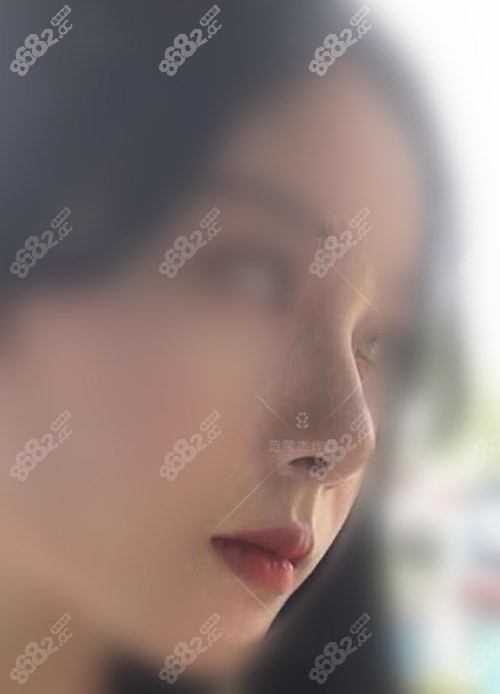 上海聯(lián)合麗格范榮杰做鼻子病例術(shù)后半年側(cè)面