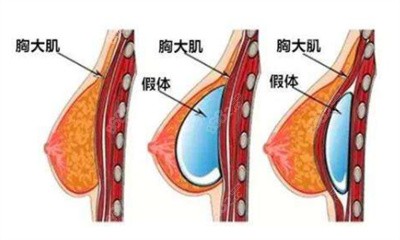 王俊河醫(yī)生隆胸的技術(shù)優(yōu)勢2