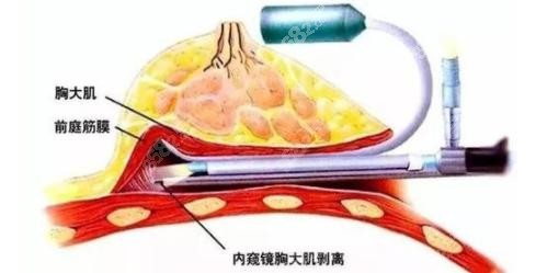 南宁华美整形假体隆胸示意图