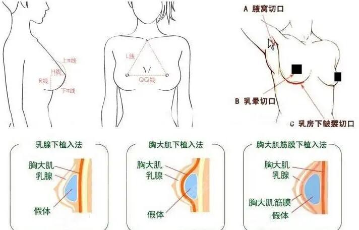 罗盛康隆胸