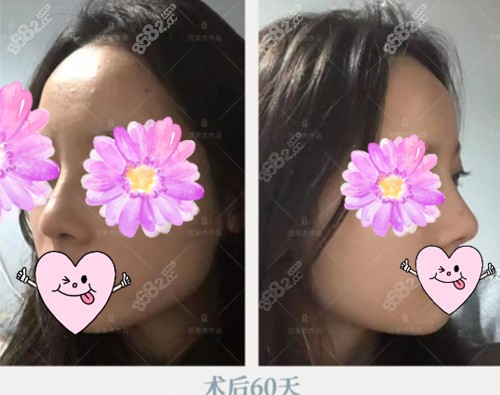范荣杰做鼻子术后60天恢复状态~