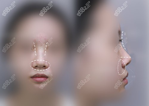 上海聯(lián)合麗格范榮杰做鼻子病例術(shù)前