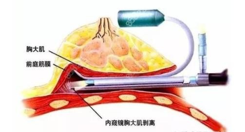 杭州维多利亚假体隆胸采用内窥镜技术隆胸创伤小