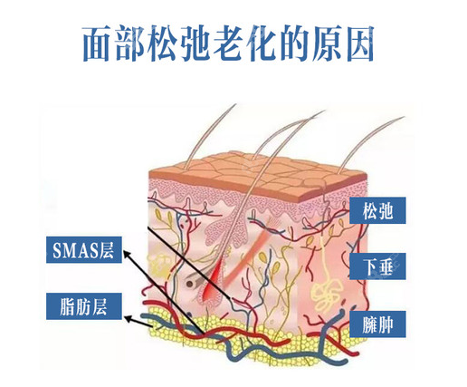 成都大拉皮手术多少钱