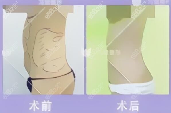 <!--<i data=20240705-sp></i>-->冯斌做5S脂肪艺术体雕瘦腰腹真人前后对比照