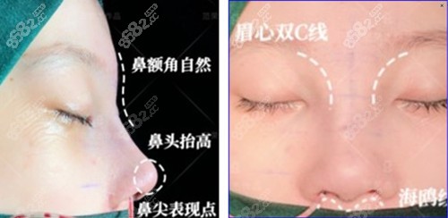 范荣杰做鼻子术后即刻