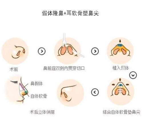 成都西区医院做耳软骨隆鼻的流程