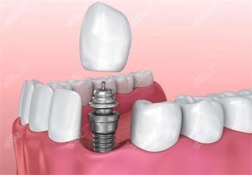 种植牙示意图