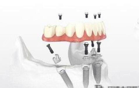 即刻负重种植牙
