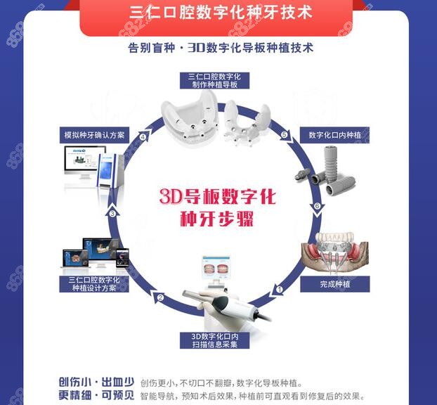 广州三仁口腔数字化种植牙技术