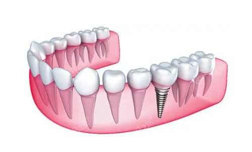 长沙中诺口腔医院种植牙