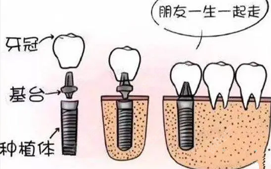 口腔种植牙