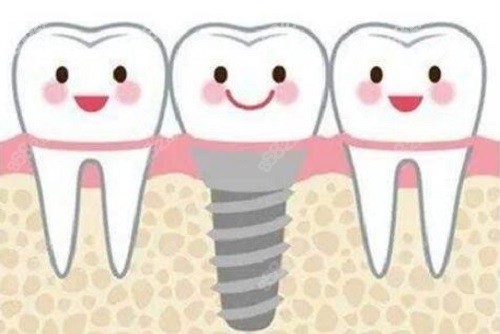 种植牙