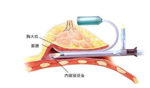 内窥镜隆胸示意图