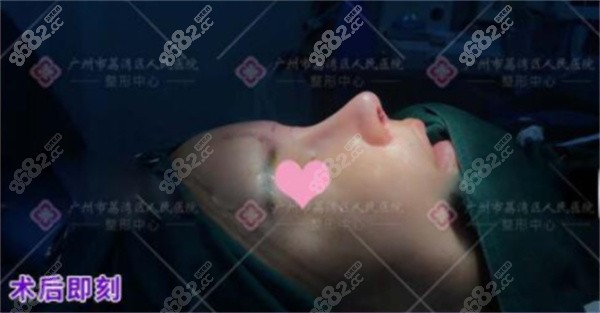 林彪斌做鼻子实例