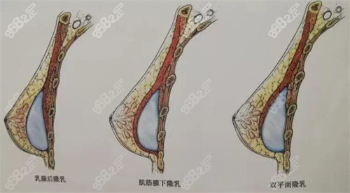 双平面隆胸示意图