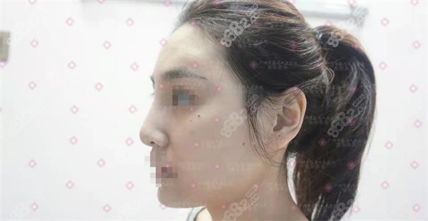 林彪斌做鼻子实例