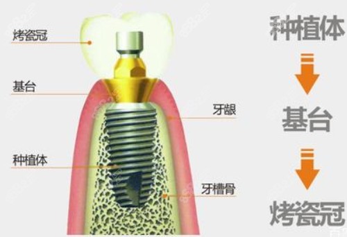 种植牙图解