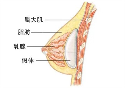 张洪波医生隆胸的技术优势