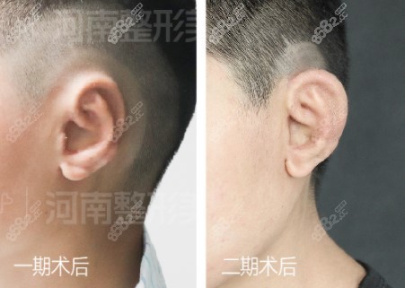 张正文做耳再造术后图