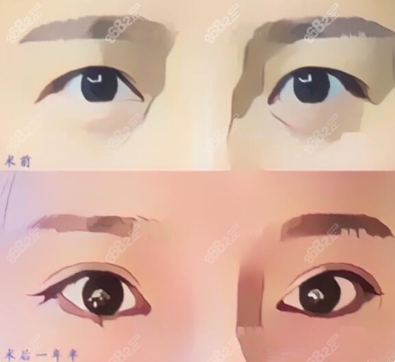 上海伯思立周珍艳做双眼皮修复真人对比照