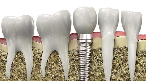 冀城口腔医院种植牙价格