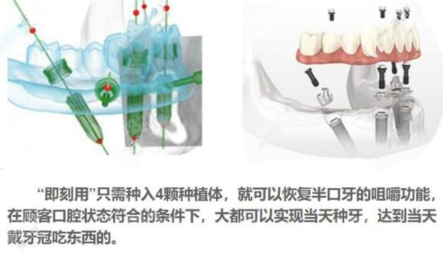 <!--<i data=20240705-sp></i>-->口腔“即刻用”种植牙技术优势