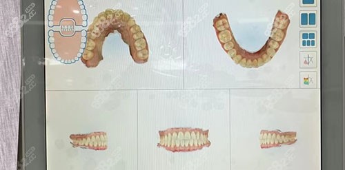 深圳和贝口腔口扫仪