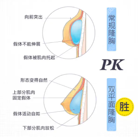 罗盛康医生2C微创免缝丰胸技术