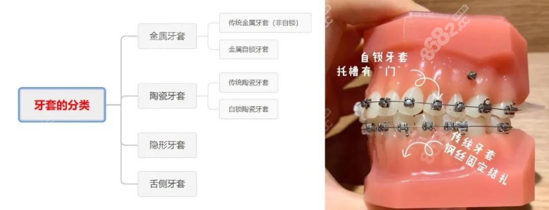 牙齿矫正分类