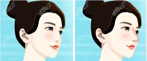 广州华美做鼻子哪个医生好