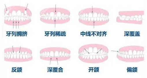 牙齿需要矫正