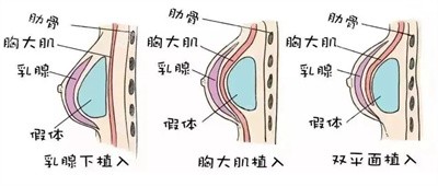 傅军医生隆胸的技术优势