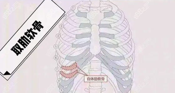肋骨再造耳朵可以保持多少年 肋骨再造耳朵可以保持多少年