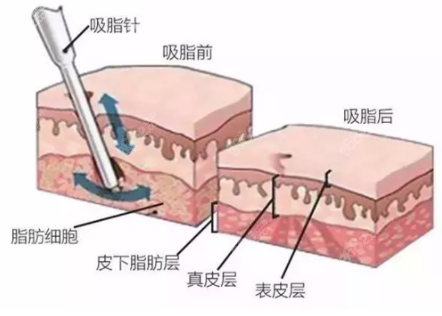 吸脂过程图