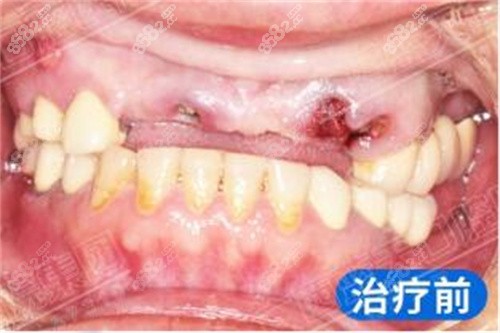 藍(lán)天口腔種牙前