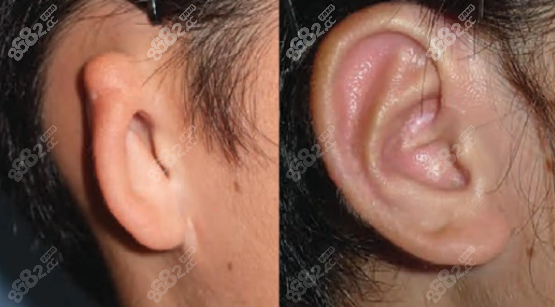 肋骨耳再造會被吸收嗎 肋骨耳再造會被吸收嗎