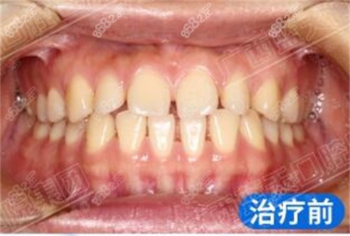 藍(lán)天口腔矯正前