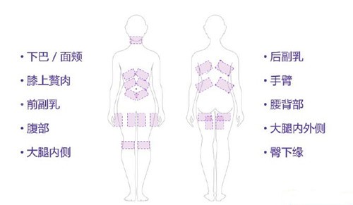 吸脂部位图解